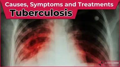 Tuberculosis article header – First Aid Article in Tweed Heads