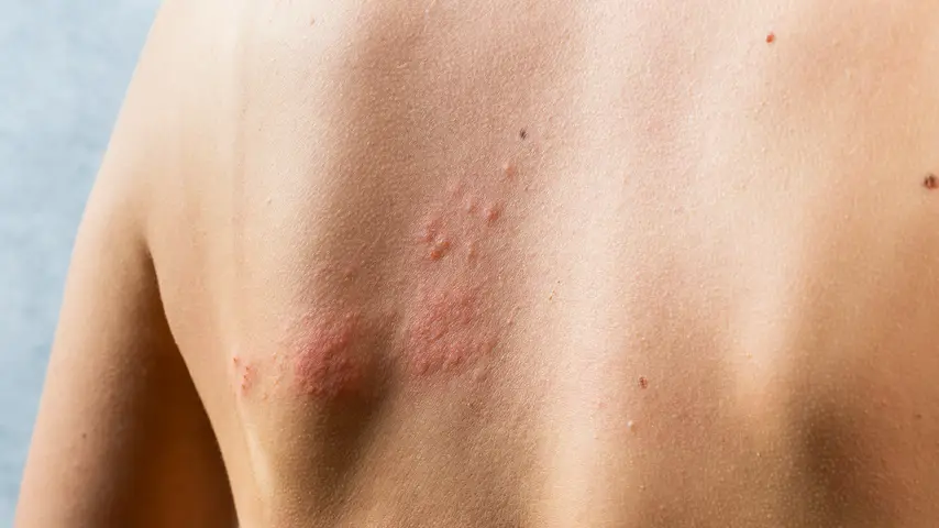 A red raised rash on a person's back
