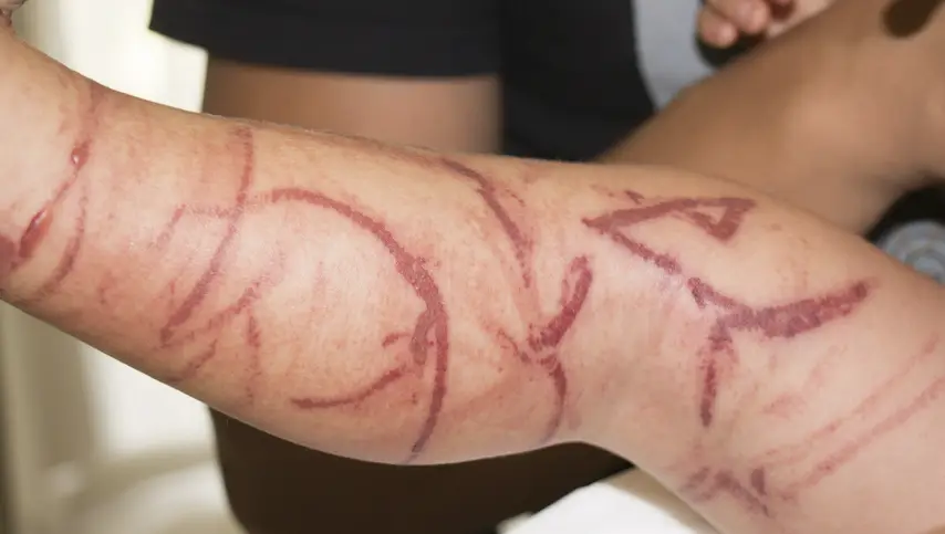 Leg covered in welts from a jellyfish sting